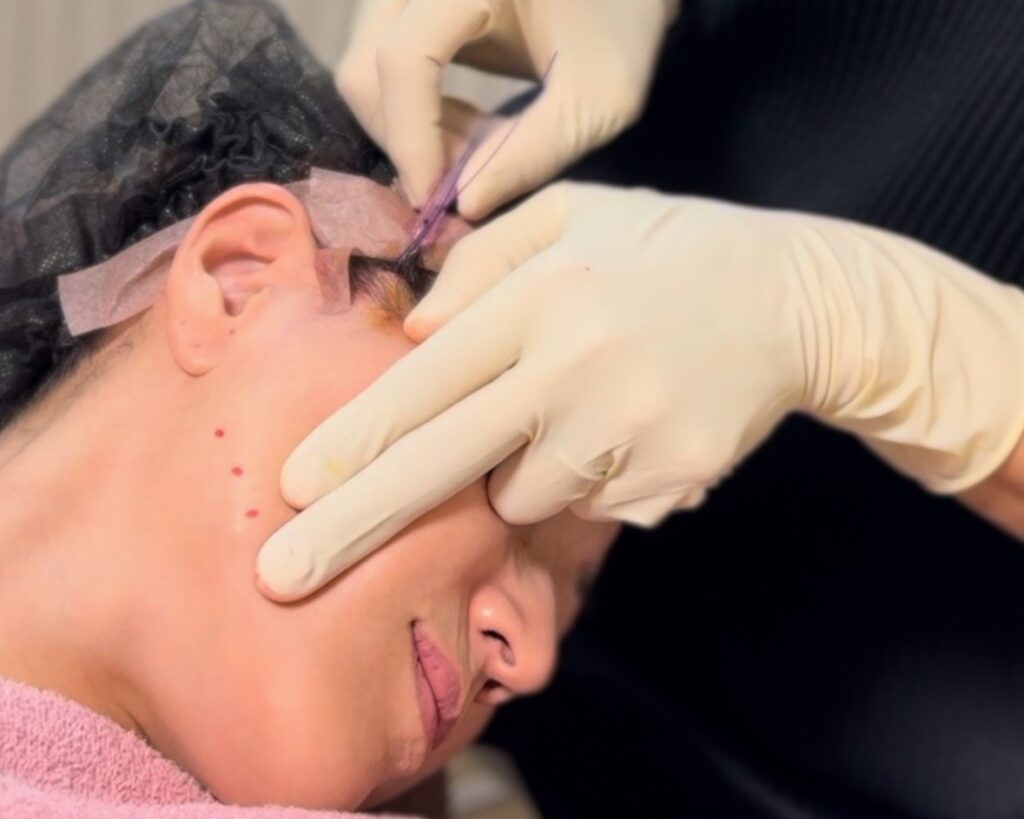 糸リフト|熊本市みやはらレディースクリニック美容診療専門サイト