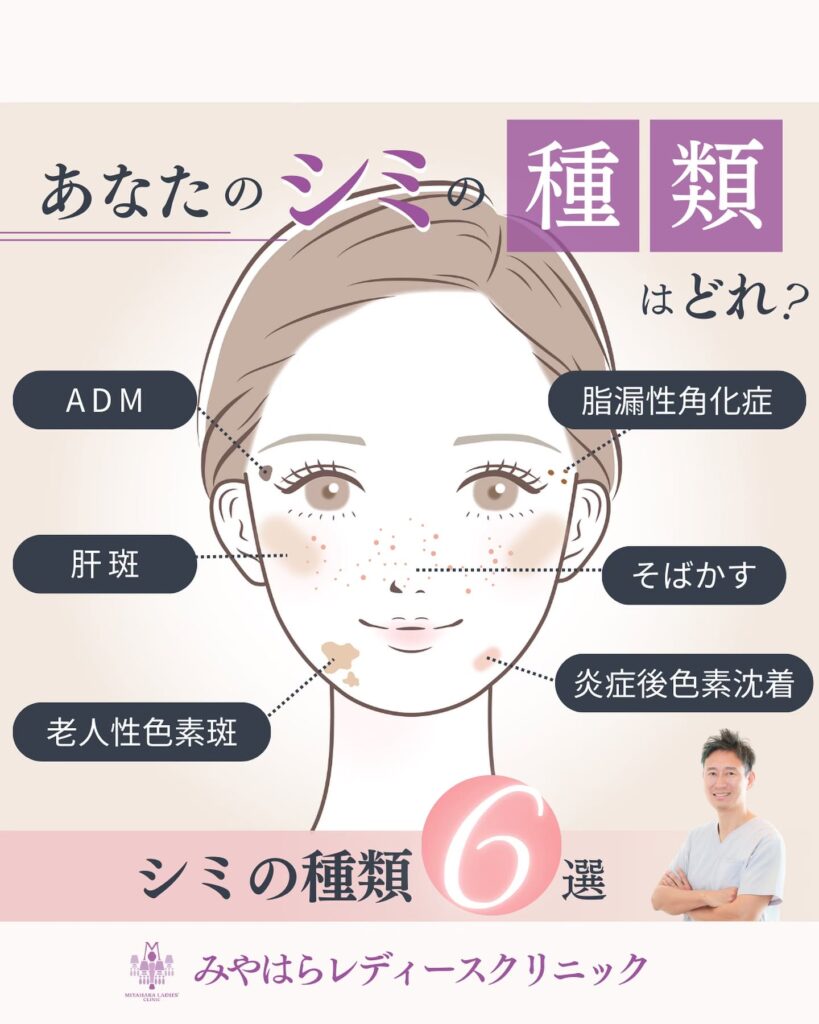 シミ種類　【シミ取り】熊本で人気が高いのはルメッカとピコレーザー！種類別の違いを解説 ｜ 熊本市 みやはらレディースクリニック 美容診療専用サイト