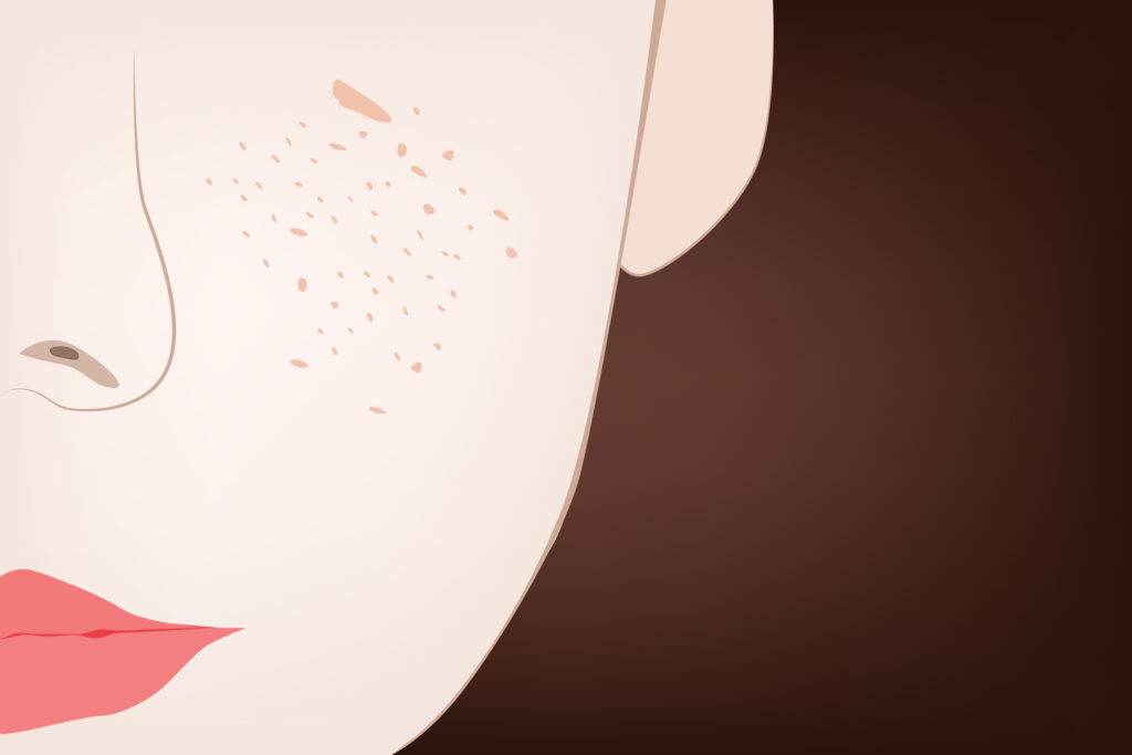 毛穴 毛穴のたるみ治療って何をする?縦毛穴の原因と美容医療でのたるみケア|熊本市 みやはらレディースクリニック 美容診療専用サイト