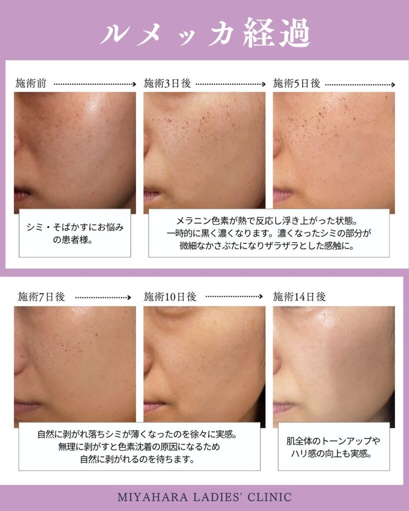 ルメッカとはどんな施術？特徴から効果の表れ方や経過まで｜熊本市みやはらレディースクリニック