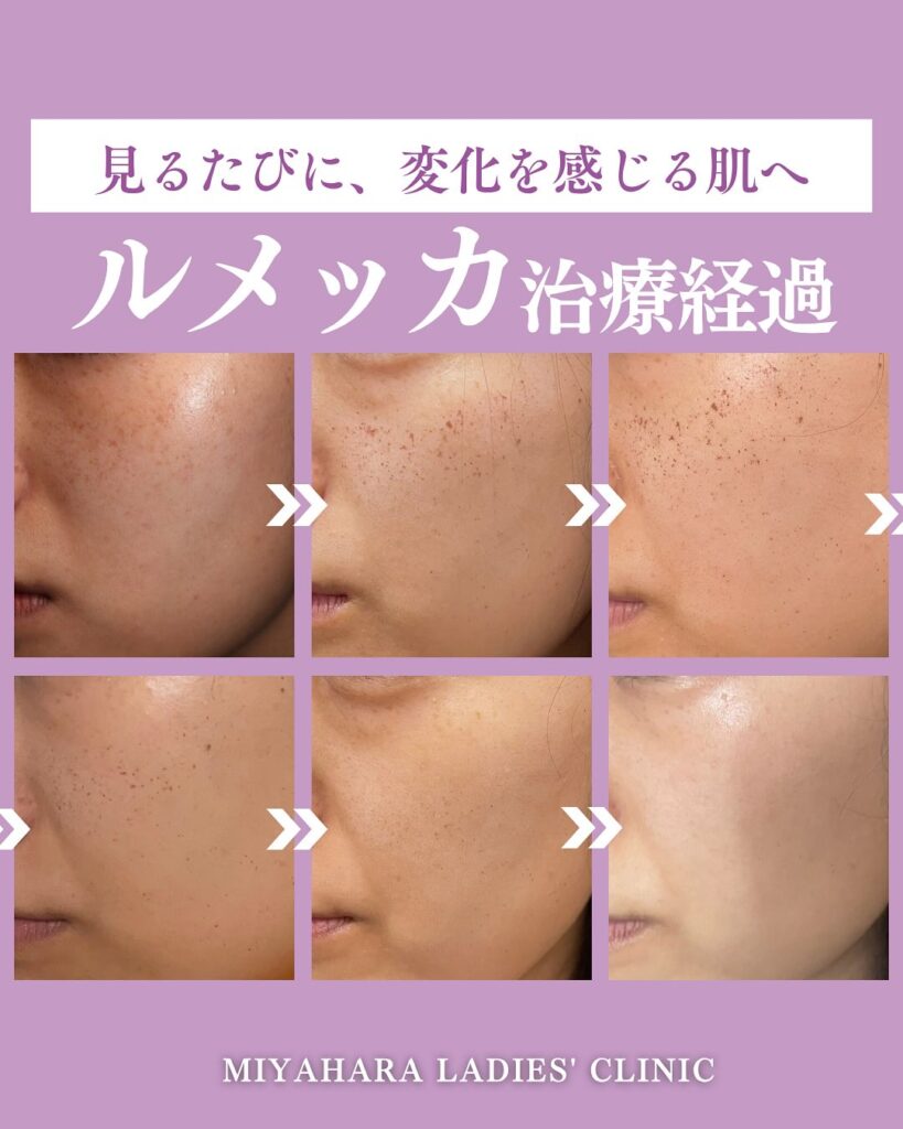 ルメッカの頻度はどれくらい？効果を実感しやすい回数・間隔をチェック｜熊本市みやはらレディースクリニック