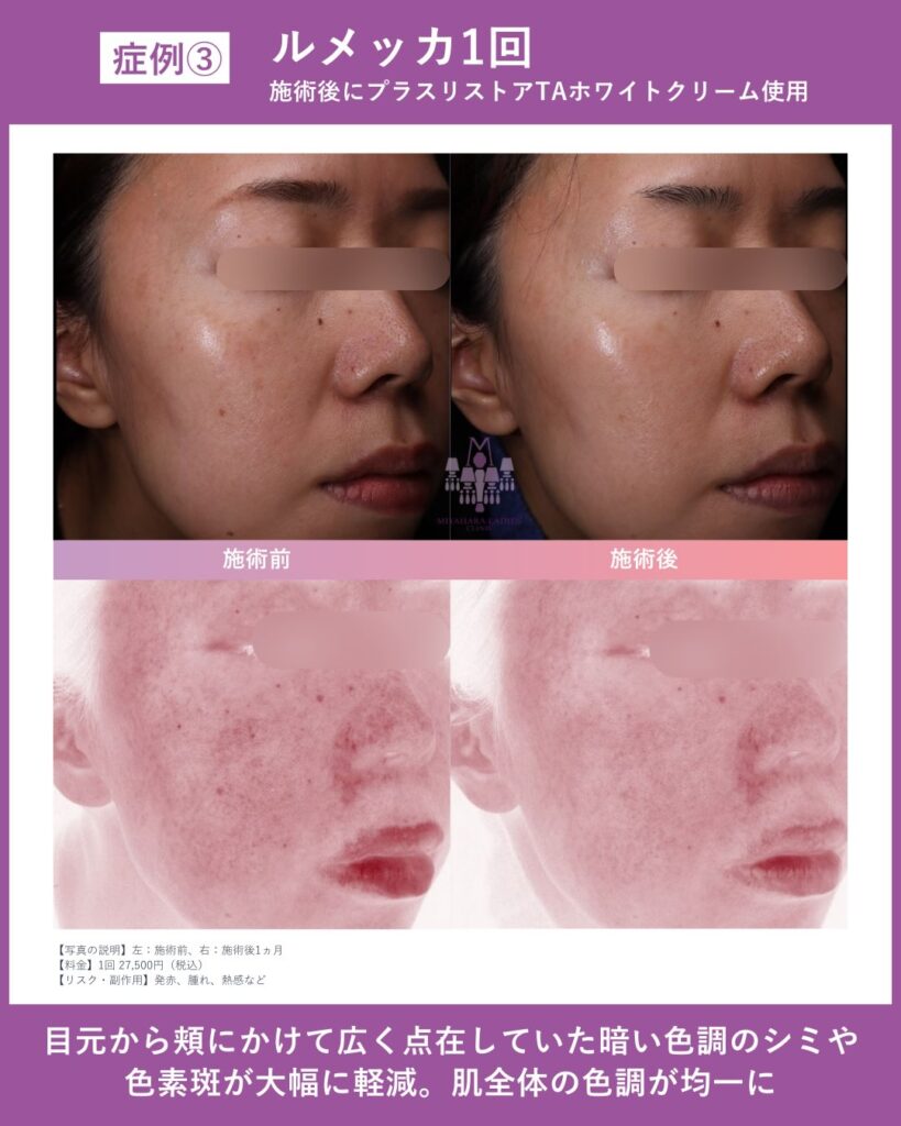 ルメッカの値段はいくら?相場や回数別費用をチェック|熊本市みやはらレディースクリニック