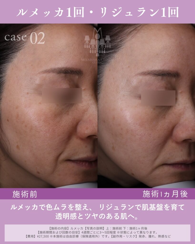 ルメッカとはどんな施術？特徴から効果の表れ方や経過まで｜熊本市みやはらレディースクリニック