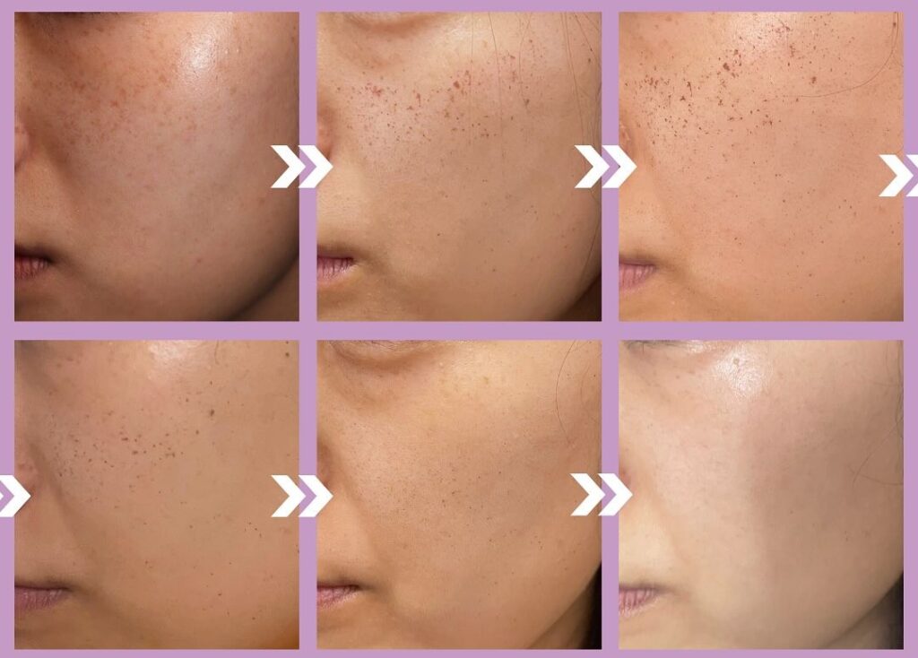 シミ取りレーザーの種類、どれを選ぶ？自分に合う治療の見極め方を解説｜熊本市みやはらレディースクリニック