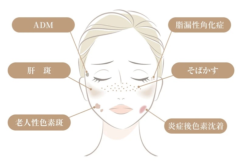顔に現れるシミの代表的な種類であるADM、肝斑、老人性色素斑、脂漏性角化症、そばかす、炎症後色素沈着の位置を示した解説用イラスト。