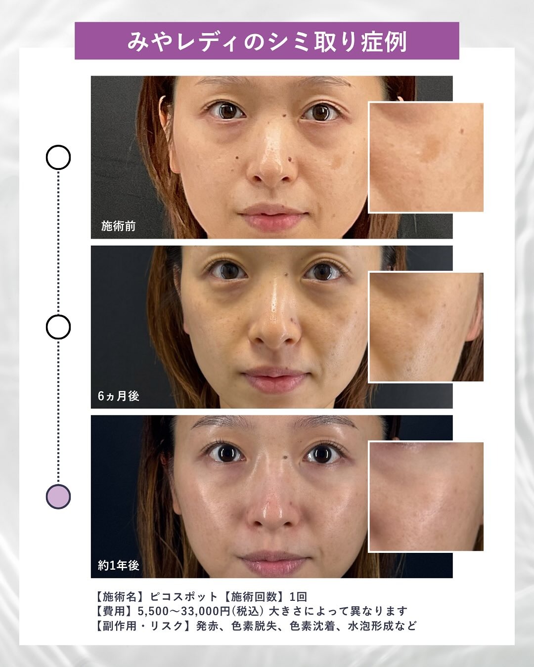 ピコスポットによるシミ取り治療の施術前、6ヶ月後、約1年後の経過を比較した症例写真。