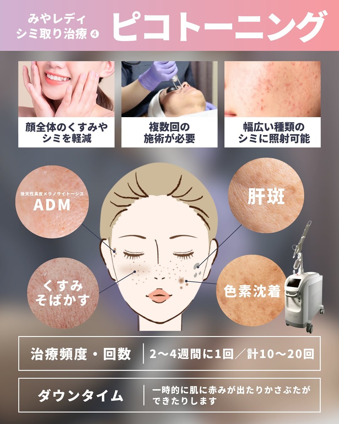 ピコトーニングによるシミ取り治療の特徴として、肝斑やADMなどの適応症状、治療頻度の目安、および赤みなどのダウンタイムを女性のイラスト付きでまとめた解説図。