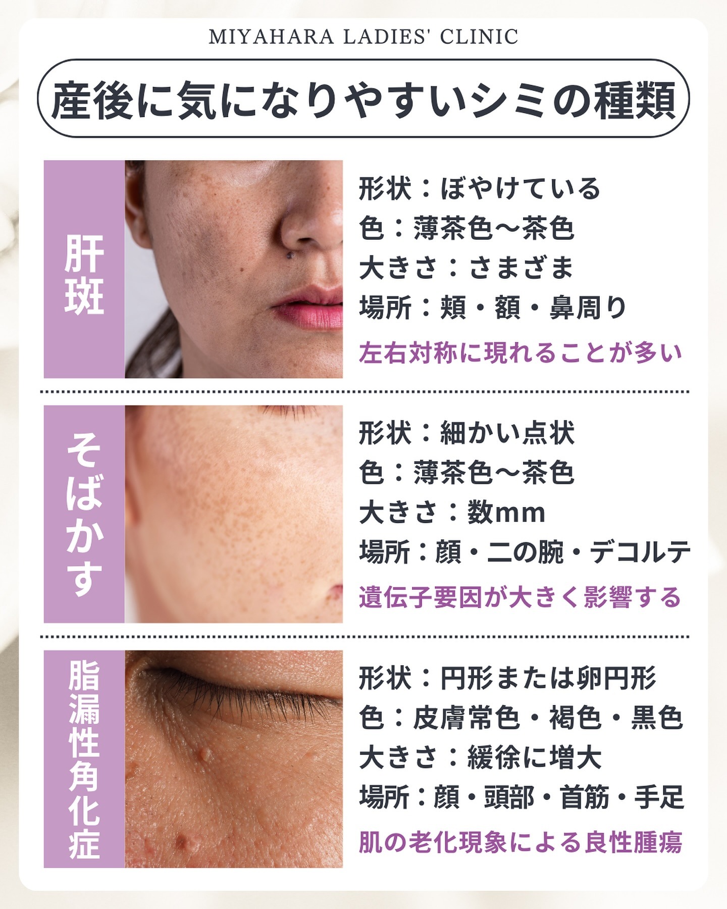 産後にできやすいシミである肝斑、そばかす、脂漏性角化症の3種類について、それぞれの症状の様子と、形状、色、できやすい部位などの特徴をまとめた比較表。