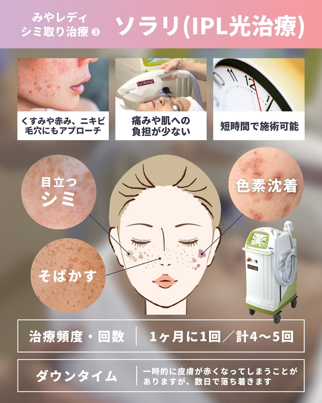 ソラリ(IPL光治療)によるシミ取り治療の特徴、シミやそばかす等の適応症状、治療頻度、ダウンタイムの目安を、女性のイラストや写真とともにまとめた解説図。