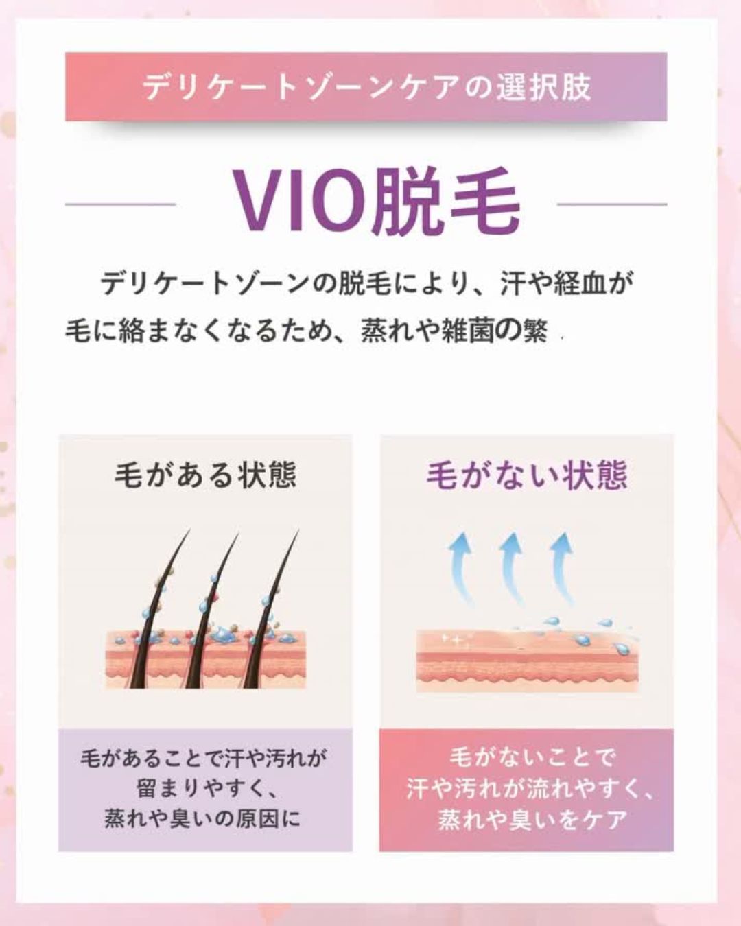 みやはらレディースクリニックのVIO脱毛についての説明画像